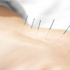 Dry Needling Bozeman, MT Absaroka Pain and Rehab